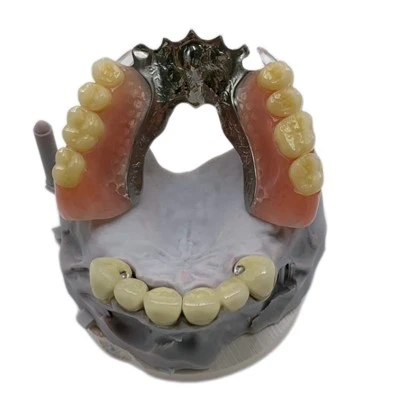 Puente PFM fijo combinado con dentadura postiza con estructura metálica parcial extraíble
